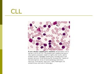 CLL
 