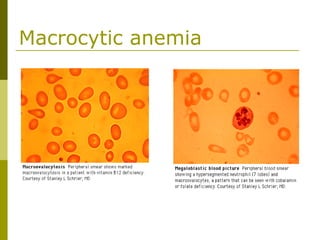 Macrocytic anemia
 