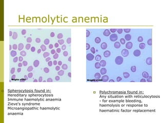 Hemolytic anemia
Spherocytosis found in:
Hereditary spherocytosis
Immune haemolytic anaemia
Zieve's syndrome
Microangiopathic haemolytic
anaemia
Polychromasia found in:
Any situation with reticulocytosis
- for example bleeding,
haemolysis or response to
haematinic factor replacement
 