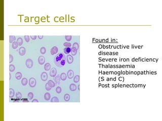 Target cells
Found in:
Obstructive liver
disease
Severe iron deficiency
Thalassaemia
Haemoglobinopathies
(S and C)
Post splenectomy
 