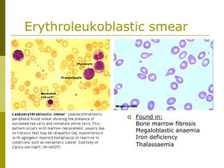 Erythroleukoblastic smear
Found in:
Bone marrow fibrosis
Megaloblastic anaemia
Iron deficiency
Thalassaemia
 