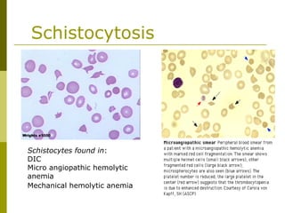 Schistocytosis
Schistocytes found in:
DIC
Micro angiopathic hemolytic
anemia
Mechanical hemolytic anemia
 
