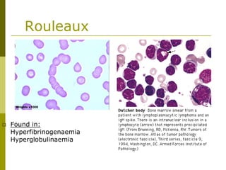 Rouleaux
Found in:
Hyperfibrinogenaemia
Hyperglobulinaemia
 