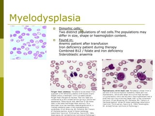Myelodysplasia
Dimorhic cells:
Two distinct populations of red cells.The populations may
differ in size, shape or haemoglobin content.
Found in:
Anemic patient after transfusion
Iron deficiency patient during therapy
Combined B12 / folate and iron deficiency
Sideroblastic anaemia
 