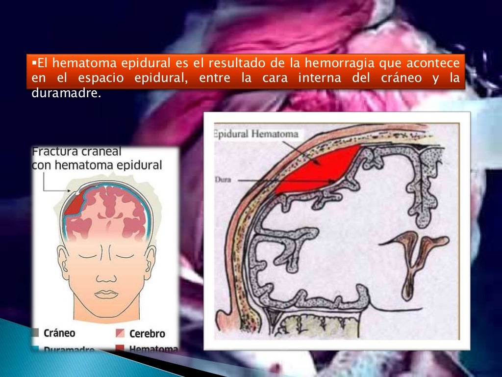 Hematoma epidural subdural agudo cronico Hematoma epidural subdural agudo cronico