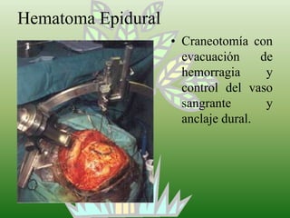 Hematoma Epidural<br />Craneotomía con evacuación de hemorragia y control del vaso sangrante y anclaje dural.<br />