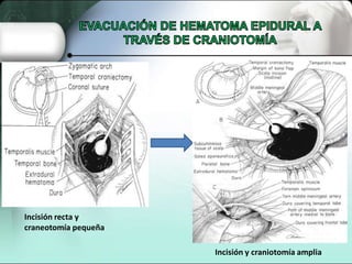 Incisión recta y
craneotomía pequeña

                      Incisión y craniotomía amplia
 