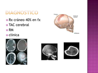  Rx  cráneo 40% en fx
 TAC cerebral
 RM
 clinica
 