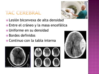  Lesión biconvexa de alta densidad
 Entre el cráneo y la masa encefálica
 Uniforme en su densidad
 Bordes definidos
 ...
