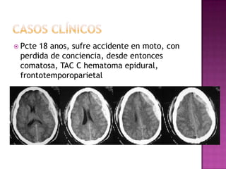  Pcte18 anos, sufre accidente en moto, con
 perdida de conciencia, desde entonces
 comatosa, TAC C hematoma epidural,
 fr...