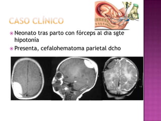  Neonato  tras parto con fórceps al día sgte
  hipotonía
 Presenta, cefalohematoma parietal dcho
 
