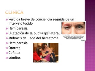  Perdida  breve de conciencia seguida de un
  intervalo lucido
 Hemiparesia
 Dilatación de la pupila ipsilateral
 Midr...