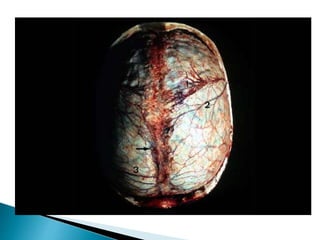  El área gris en la
parte superior
externa es el
hematoma,
causando
desviación de la
línea media y
compresión
ventricular.
 