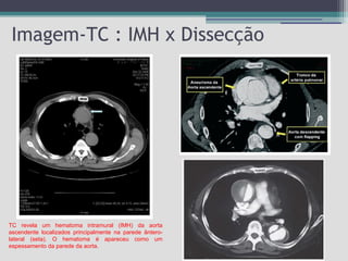 Imagem-TC : IMH x Dissecção

TC revela um hematoma intramural (IMH) da aorta
ascendente localizados principalmente na parede ânterolateral (seta). O hematoma é apareceu como um
espessamento da parede da aorta.

 