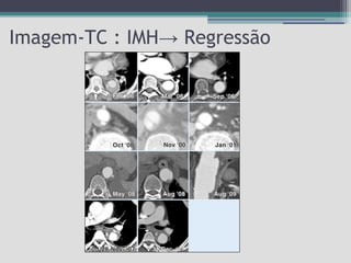Imagem-TC : IMH→ Regressão

 