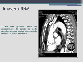 Imagem-RNM

O IMH está apareceu como um
espessamento da parede da aorta
estendido no arco aórtico comprimindo
a origem da artéria inominada

 