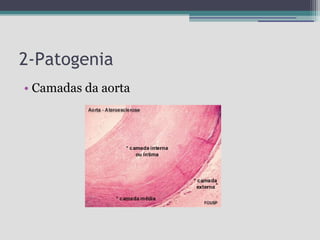 2-Patogenia
• Camadas da aorta

 