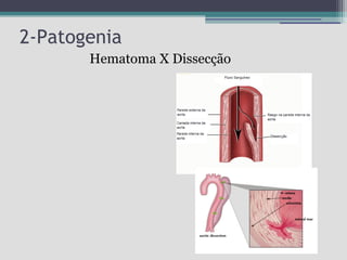 2-Patogenia
Hematoma X Dissecção

 