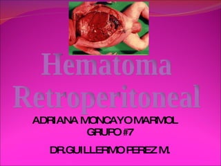 Hematoma  Retroperitoneal ADRIANA MONCAYO MARMOL GRUPO #7 DR.GUILLERMO PEREZ M. 