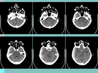 Comprehensive Clinical Case Study and Management of Acute Subdural ...