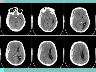 Comprehensive Clinical Case Study and Management of Acute Subdural ...