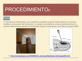 PROCEDIMIENTO6
¡
6. http://revistasergon.com/FERRER/m_tecnicas/files/basic-html/page284.html
Pasos
3. Se presiona lentamente y con cuidado la superficie ungueal hasta perforar la uña para
facilitar la evacuación del hematoma. La sangre acumulada se evacúa rápidamente por la
presión relativamente grande en el pequeño espacio subungueal. Se limpia con gasa estéril.
 