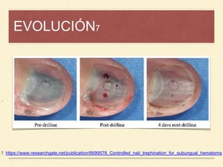 EVOLUCIÓN7
¡
7. https://www.researchgate.net/publication/6699578_Controlled_nail_trephination_for_subungual_hematoma
 