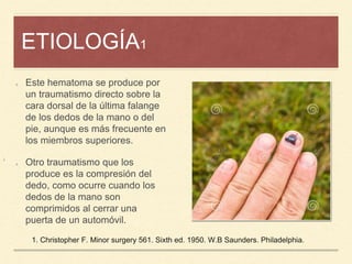 ETIOLOGÍA1
¡
Este hematoma se produce por
un traumatismo directo sobre la
cara dorsal de la última falange
de los dedos de la mano o del
pie, aunque es más frecuente en
los miembros superiores.
Otro traumatismo que los
produce es la compresión del
dedo, como ocurre cuando los
dedos de la mano son
comprimidos al cerrar una
puerta de un automóvil.
1. Christopher F. Minor surgery 561. Sixth ed. 1950. W.B Saunders. Philadelphia.
 