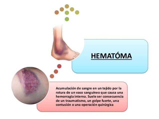 Equimosis: Qué Es, Causas Y Tratamiento – KUYE