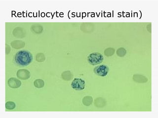Reticulocyte (supravital stain)
 