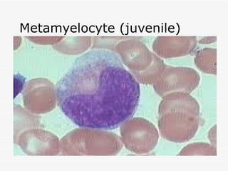 Metamyelocyte (juvenile)
 