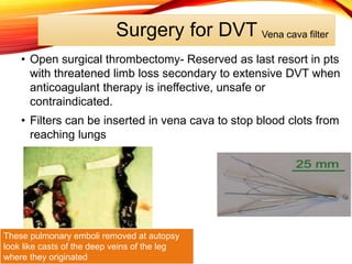Surgery for DVT
• Open surgical thrombectomy- Reserved as last resort in pts
with threatened limb loss secondary to extensive DVT when
anticoagulant therapy is ineffective, unsafe or
contraindicated.
• Filters can be inserted in vena cava to stop blood clots from
reaching lungs
These pulmonary emboli removed at autopsy
look like casts of the deep veins of the leg
where they originated
Vena cava filter
 