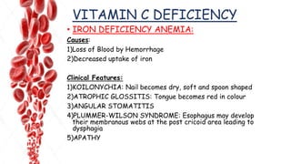 VITAMIN C DEFICIENCY
• IRON DEFICIENCY ANEMIA:
Causes:
1)Loss of Blood by Hemorrhage
2)Decreased uptake of iron
Clinical Features:
1)KOILONYCHIA: Nail becomes dry, soft and spoon shaped
2)ATROPHIC GLOSSITIS: Tongue becomes red in colour
3)ANGULAR STOMATITIS
4)PLUMMER-WILSON SYNDROME: Esophagus may develop
their membranous webs at the post cricoid area leading to
dysphagia
5)APATHY
 