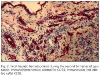 Hematopoyesis
2. Fase Hepática
Predomina la eritropoyesis, pero se detectan elementos de la
serie granulocítica y megacari...