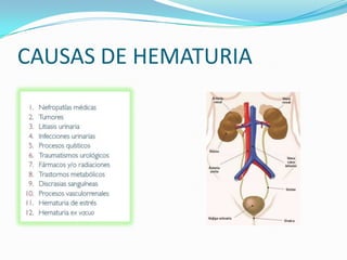 CAUSAS DE HEMATURIA