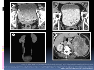 ANNE M. SILAS, MD, FRCPC. EVALUATING THE UROTHELIUM WITH CT UROGRAPHY: ARE WE THERE YET?. SEMINARS IN ROENTGENOLOGY. 2009.
ZACHARY W. WASHBURN, MD, JONATHAN R. DILLMAN, MD, RICHARD H. COHAN. COMPUTED TOMOGRAPHIC UROGRAPHY UPDATE:AN EVOLVING URINARY TRACT IMAGING MODALITY.
                                                                                               SEMIN ULTRASOUND CT MRI 30:233-245 © 2009 ELSEVIER INC.
 