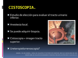 CISTOSCOPIA.
 Estudio de elección para evaluar el tracto urinario
  inferior.

 Anestesia local.

 Se puede adquirir biopsia.

 Cistoscopia + imagen tracto
  superior.

 Ureteropielorrenoscopia?
       EDWARD J. YUN, MD, MAXWELL V. MENG, MD. EVALUATION OF THE PATIENT WITH HEMATURIA. MED CLIN N AM 88 (2004) 329–343.
                       MASAHITO JIMBO, MD. EVALUATION AND MANAGEMENT OF HEMATURIA. PRIM CARE CLIN OFFICE PRACT 37 (2010) 461–472.
 