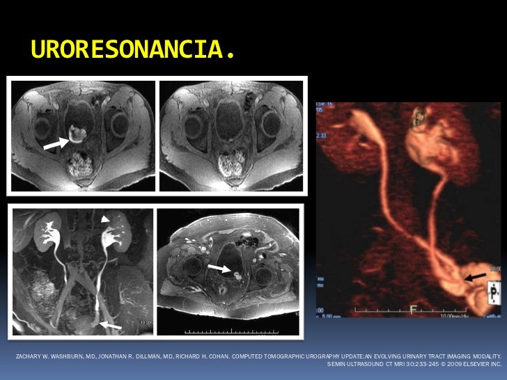 Hematuria Macroscopica Asintomatica En Hombres