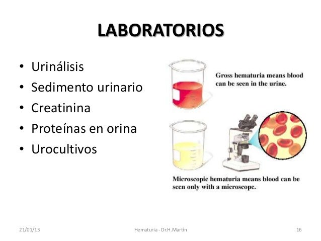 Hematuria Macroscopica Asintomatica En Hombres