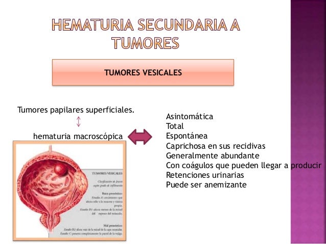 Hematuria Macroscopica Asintomatica En Hombres