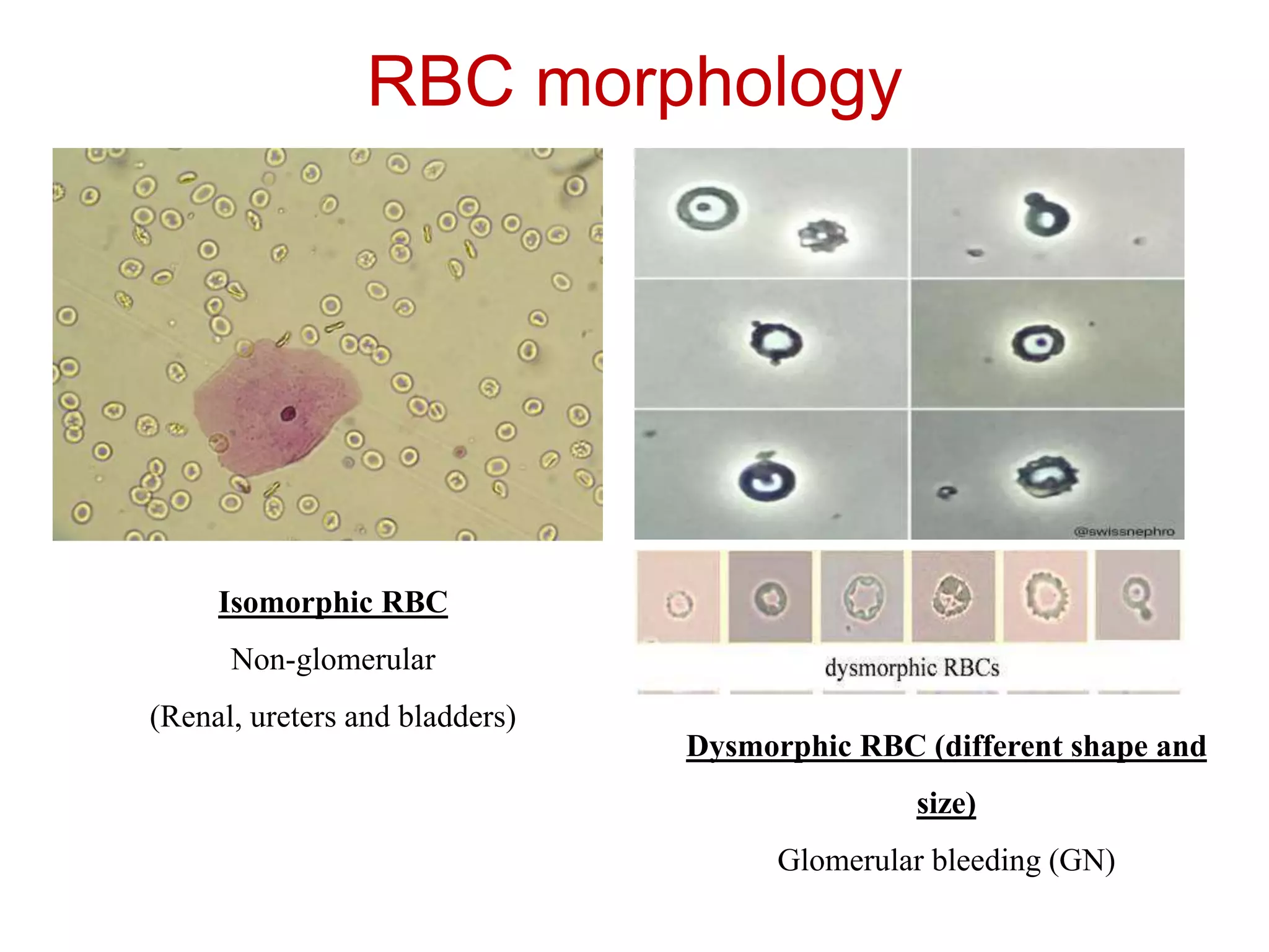 Hematuria | PPTX