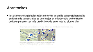 Comprehensive Overview of Hematuria: Causes, Diagnosis, and Imaging | PPTX