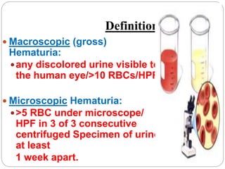 Hematuria and acute glomeulonephritis | PPT