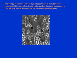 Shape of ClotsAmorphous clots : bladder or prostatic urethral origin