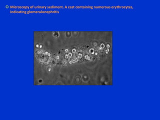 Vermiform (wormlike) clots, particularly if associated with flank pain : the upper urinary tract : ureterDuration of HematuriaTransient HematuriaBenign & without any obvious etiology in 39%of young adults 8-9% of adults >50y/o – malignancyPersistent HematuriaDefined as three positive urinalyses, based on a test strip and microscopic examination, over a 2- to 3- week periodMicroscopic – 5% malignancyMacroscopic – 20% malignancy