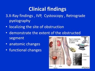PoststreptococcalglomerulonephritisNon-glomerular Hematuria Non-glomerular hematuria or essential hematuria includes primarily urologic rather than nephrologic diseasesCommon causes of essential hematuria include urologic tumors, stones, and UTIs