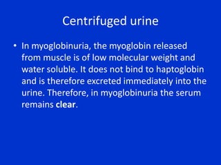 Centrifuged urineIn hemoglobinuria, the supernatant will be pink. This is because free hemoglobin in the serum binds to haptoglobin, which is water insoluble and has a high molecular weight. This complex remains in the serum, causing a pink color. Free hemoglobin will appear in the urine only when all of the haptoglobin-binding sites have been saturated. 