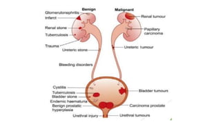 Approach to Hematuria | PPTX