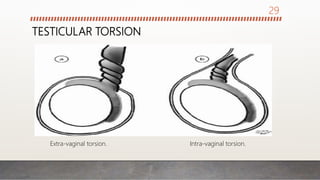TESTICULAR TORSION
Extra-vaginal torsion. Intra-vaginal torsion.
29
 