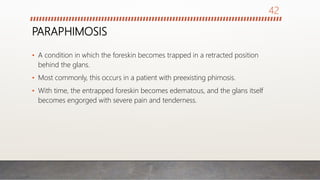 PARAPHIMOSIS
• A condition in which the foreskin becomes trapped in a retracted position
behind the glans.
• Most commonly, this occurs in a patient with preexisting phimosis.
• With time, the entrapped foreskin becomes edematous, and the glans itself
becomes engorged with severe pain and tenderness.
42
 